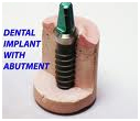 Dental Implants, Dental Implants Treatment In Delhi