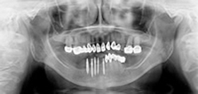 TRX-OP Implant, TRX-OP One-Piece Implant
