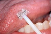 Brush Biopsy