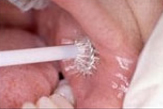 Brush Biopsy