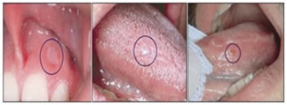 Brush Biopsy