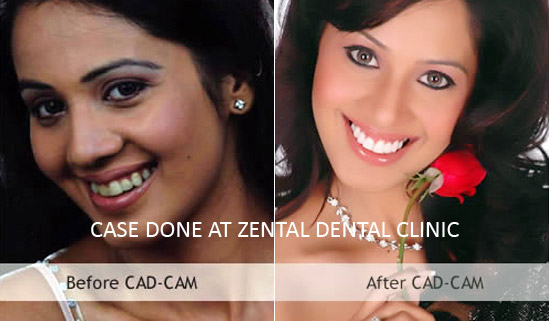 CAD CAM dentistry in delhi, Dental CAD CAM technology in delhi
