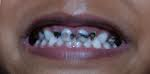 Child Dentistry In Delhi, Dental care for kids, Pediatric Dentistry In Delhi