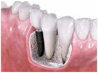Dental Implants In Delhi, Dental Implants In India, Dental Implants Cost In India