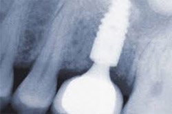 Nobel Biocare Dental implants In Delhi