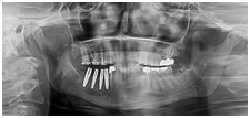 Nobel Biocare, Nobel Biocare Dental implants In Delhi