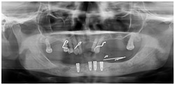 Uniti Implant