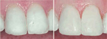 Dental Veneers Laminates, Porcelain laminate veneers, Porcelain Laminate Veneers in Delhi