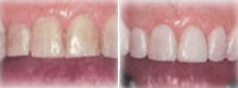 Porcelain Veneers Delhi India, Dental Veneers Laminates, Porcelain laminate veneers, Porcelain Laminate Veneers in Delhi