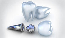 Minimal Surgical Implants, Dental Implants Clinic In Delhi, Dental Implants Minimal Surgical Implants, Dental Implants Clinic In Delhi, Dental Implants